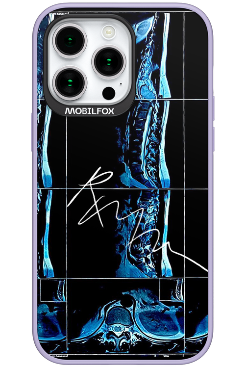 RMN Scolioza - Apple iPhone 15 Pro Max