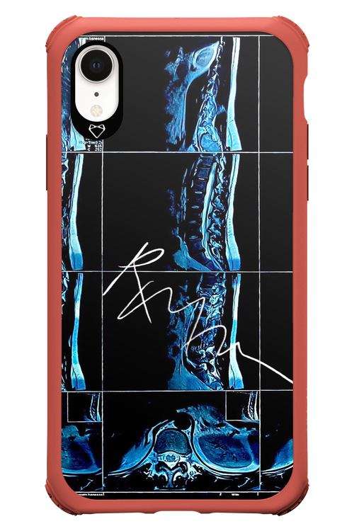 RMN Scolioza 2.0 - Apple iPhone XR