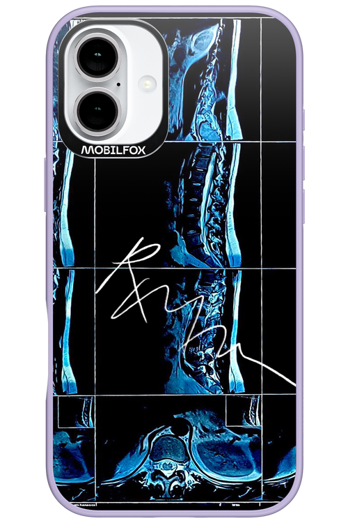 RMN Scolioza 2.0 - Apple iPhone 16 Plus