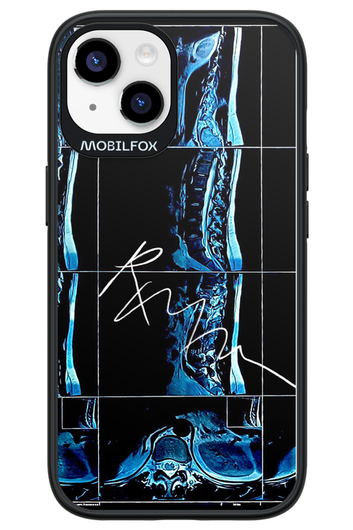 RMN Scolioza 2.0 - Apple iPhone 14