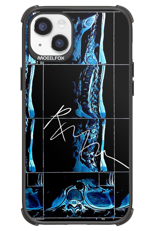 RMN Scolioza 2.0 - Apple iPhone 14 Plus