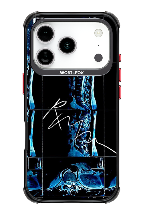 RMN Scolioza 2.0 - Apple iPhone 17 Pro