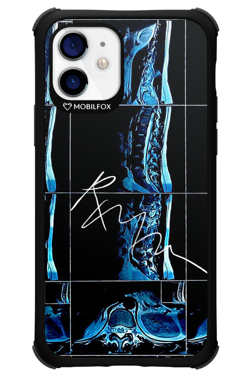 RMN Scolioza 2.0 - Apple iPhone 12