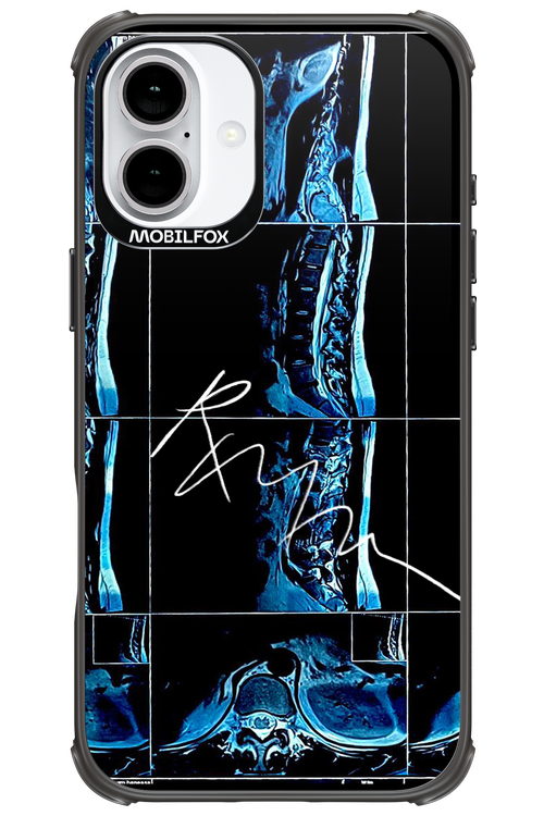RMN Scolioza 2.0 - Apple iPhone 16 Plus