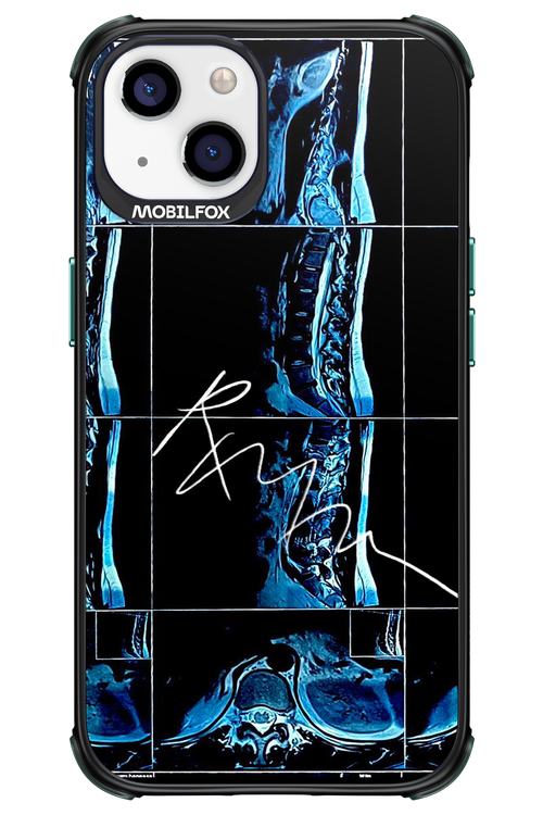 RMN Scolioza 2.0 - Apple iPhone 13