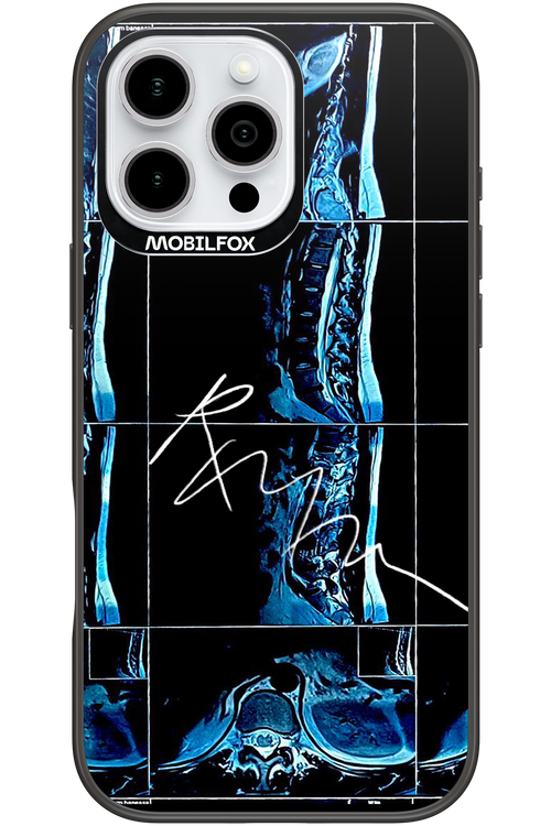 RMN Scolioza 2.0 - Apple iPhone 16 Pro Max