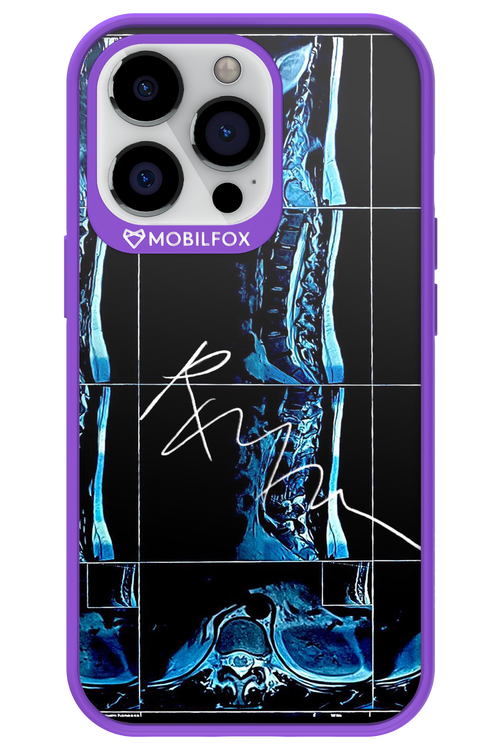 RMN Scolioza 2.0 - Apple iPhone 13 Pro