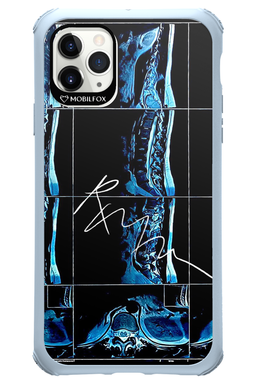RMN Scolioza 2.0 - Apple iPhone 11 Pro Max