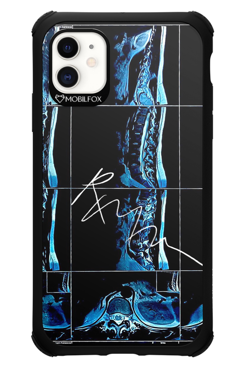 RMN Scolioza 2.0 - Apple iPhone 11