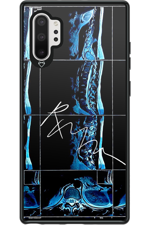 RMN Scolioza 2.0 - Samsung Galaxy Note 10+