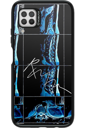 RMN Scolioza 2.0 - Huawei P40 Lite