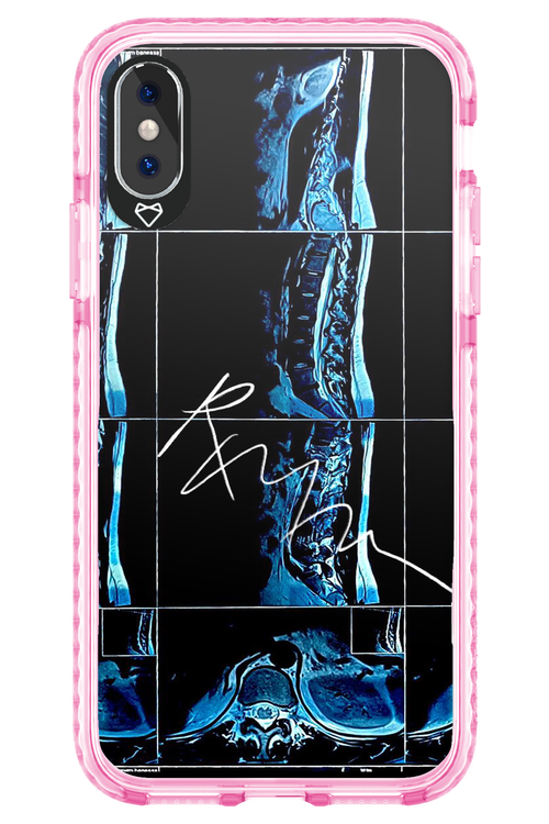 RMN Scolioza 2.0 - Apple iPhone X