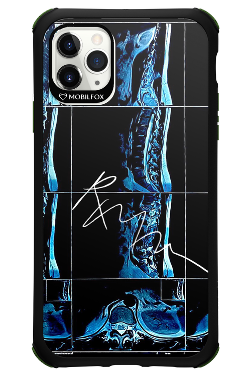 RMN Scolioza 2.0 - Apple iPhone 11 Pro Max