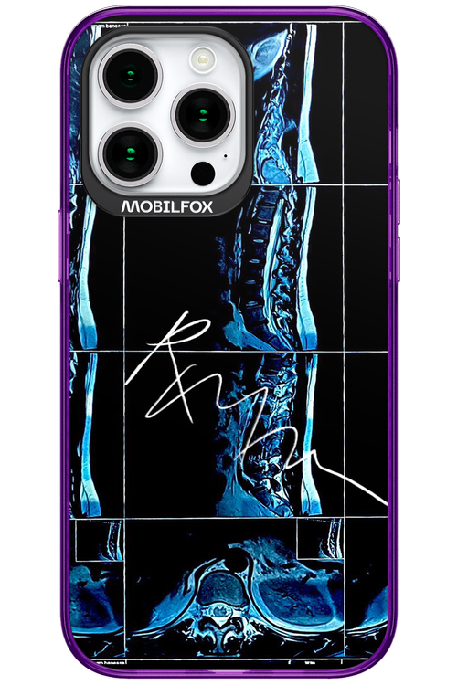 RMN Scolioza 2.0 - Apple iPhone 15 Pro Max