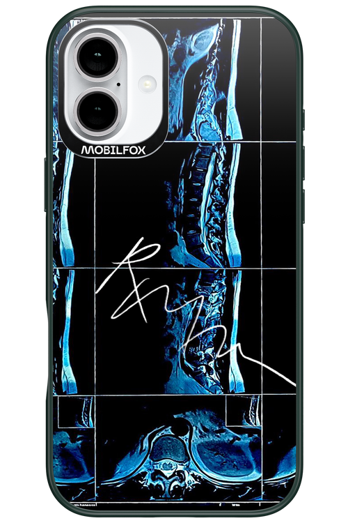 RMN Scolioza 2.0 - Apple iPhone 16 Plus