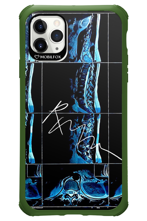 RMN Scolioza 2.0 - Apple iPhone 11 Pro Max