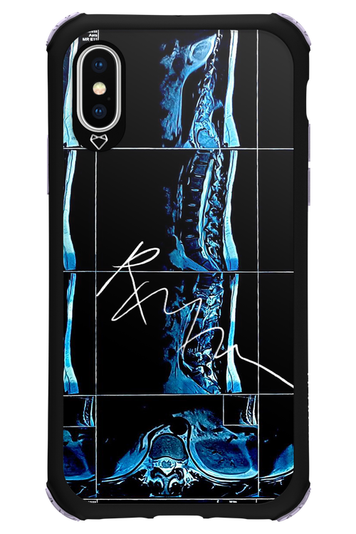 RMN Scolioza 2.0 - Apple iPhone X
