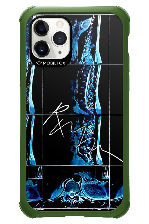 RMN Scolioza 2.0 - Apple iPhone 11 Pro