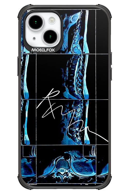 RMN Scolioza 2.0 - Apple iPhone 15 Plus