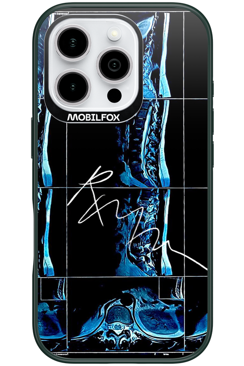 RMN Scolioza - Apple iPhone 16 Pro