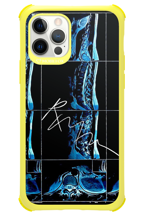 RMN Scolioza 2.0 - Apple iPhone 12 Pro
