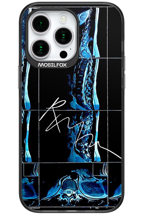 RMN Scolioza 2.0 - Apple iPhone 15 Pro Max