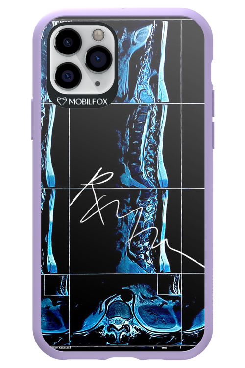 RMN Scolioza 2.0 - Apple iPhone 11 Pro