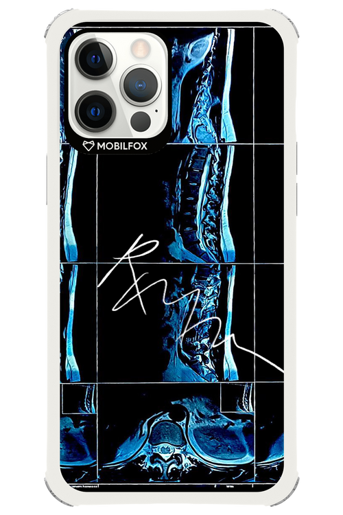 RMN Scolioza 2.0 - Apple iPhone 12 Pro Max