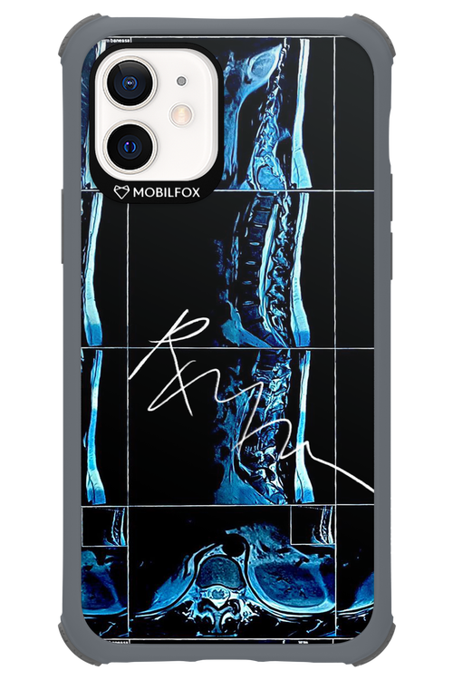 RMN Scolioza 2.0 - Apple iPhone 12