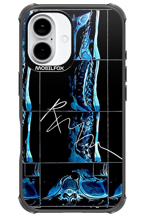 RMN Scolioza 2.0 - Apple iPhone 16
