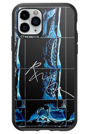 RMN Scolioza 2.0 - Apple iPhone 11 Pro