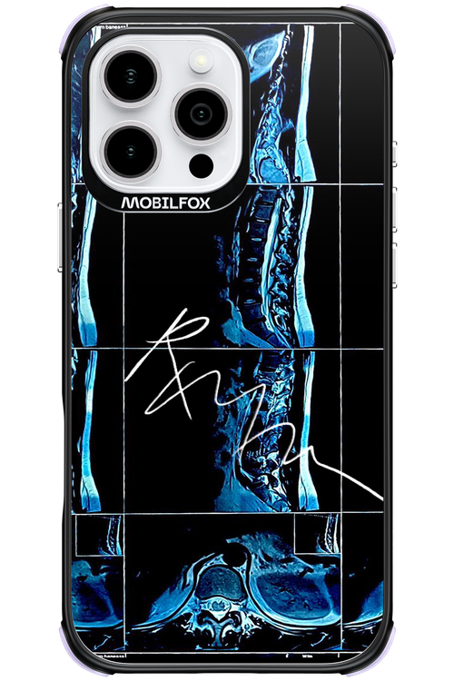 RMN Scolioza 2.0 - Apple iPhone 16 Pro Max
