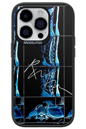 RMN Scolioza 2.0 - Apple iPhone 14 Pro