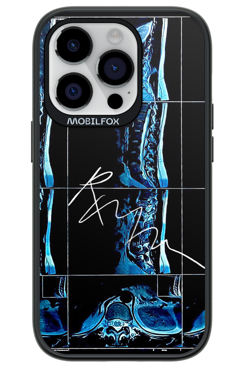 RMN Scolioza 2.0 - Apple iPhone 14 Pro