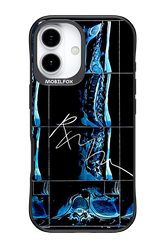 RMN Scolioza 2.0 - Apple iPhone 17