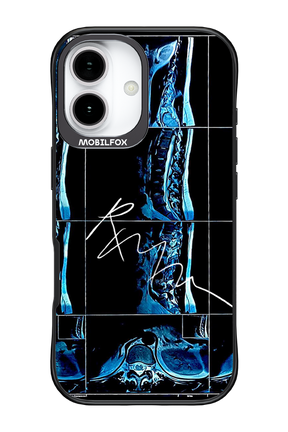 RMN Scolioza 2.0 - Apple iPhone 17