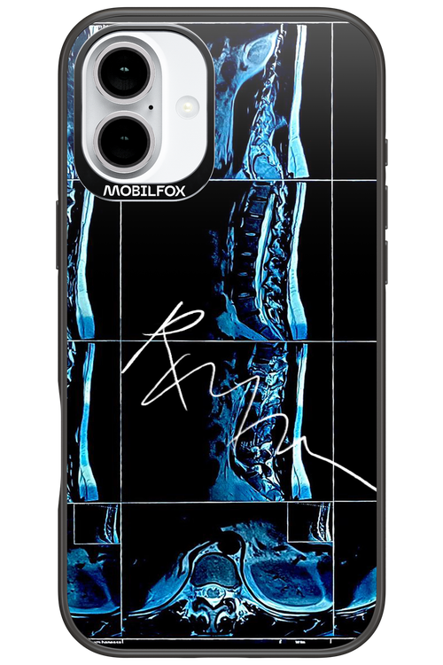 RMN Scolioza 2.0 - Apple iPhone 16 Plus