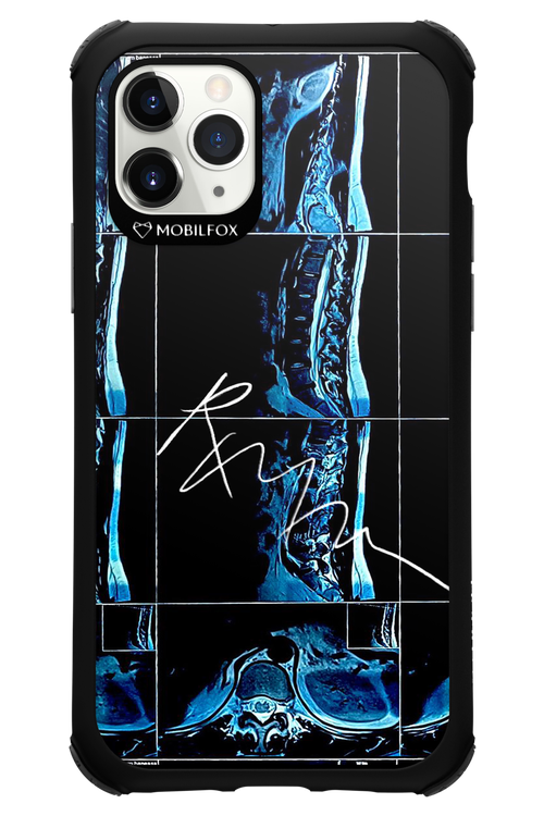 RMN Scolioza 2.0 - Apple iPhone 11 Pro