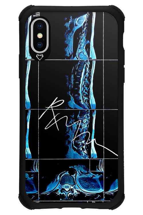 RMN Scolioza 2.0 - Apple iPhone X