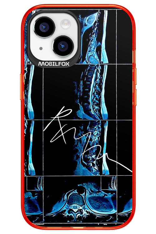 RMN Scolioza 2.0 - Apple iPhone 15