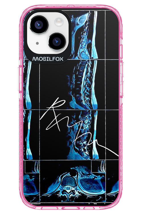 RMN Scolioza 2.0 - Apple iPhone 14