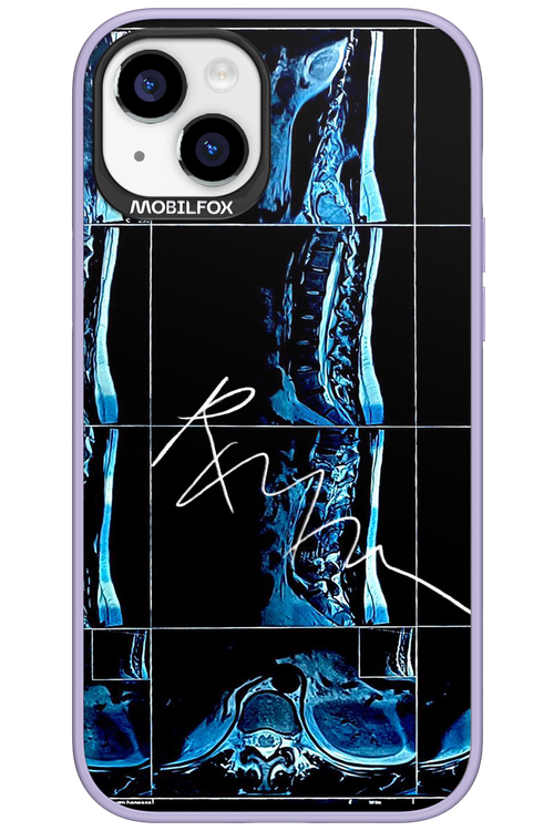 RMN Scolioza 2.0 - Apple iPhone 15 Plus
