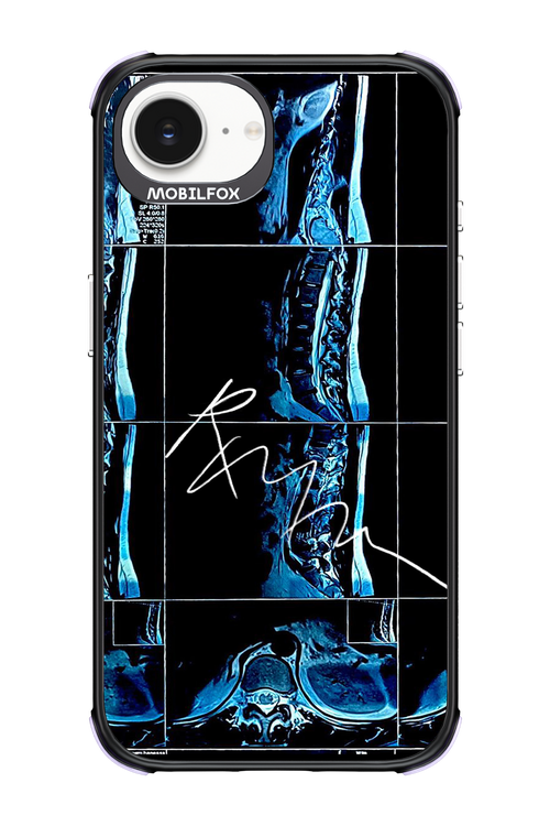 RMN Scolioza 2.0 - Apple iPhone 16e