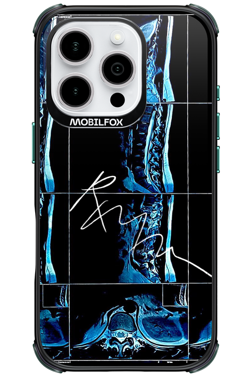 RMN Scolioza - Apple iPhone 16 Pro