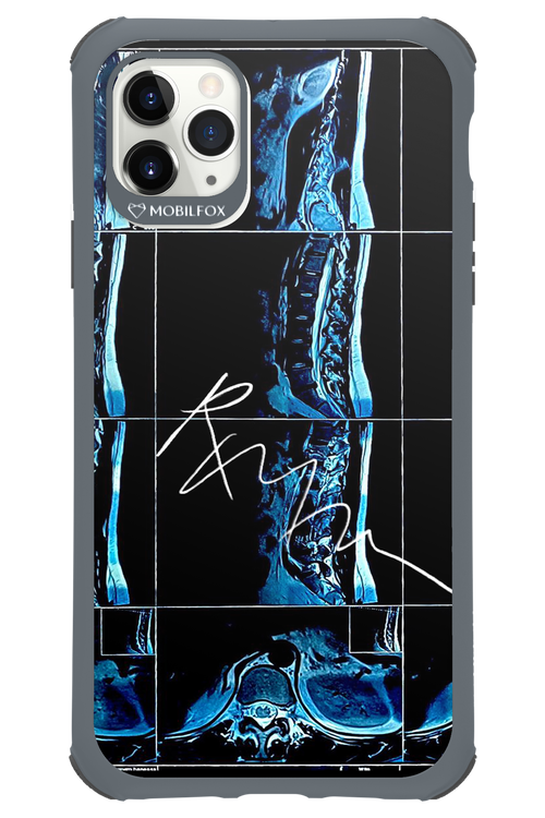 RMN Scolioza 2.0 - Apple iPhone 11 Pro Max
