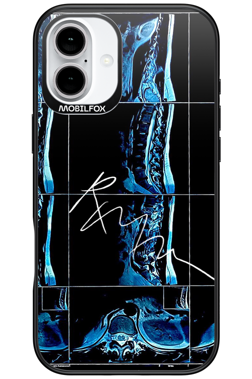 RMN Scolioza 2.0 - Apple iPhone 16 Plus