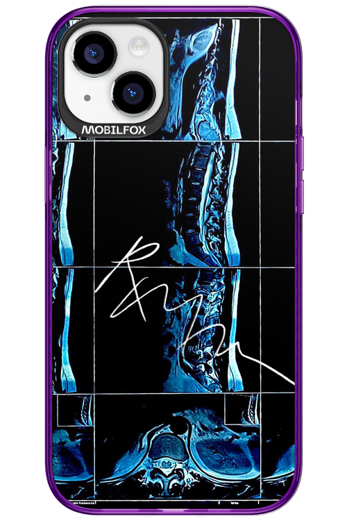 RMN Scolioza 2.0 - Apple iPhone 15 Plus