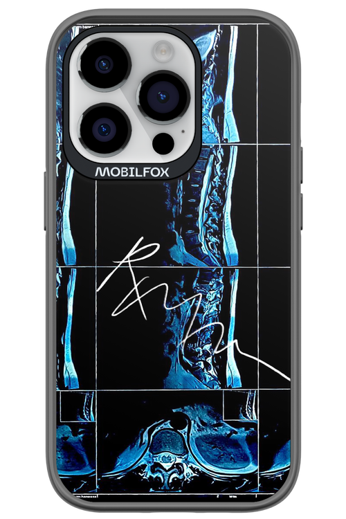 RMN Scolioza 2.0 - Apple iPhone 14 Pro