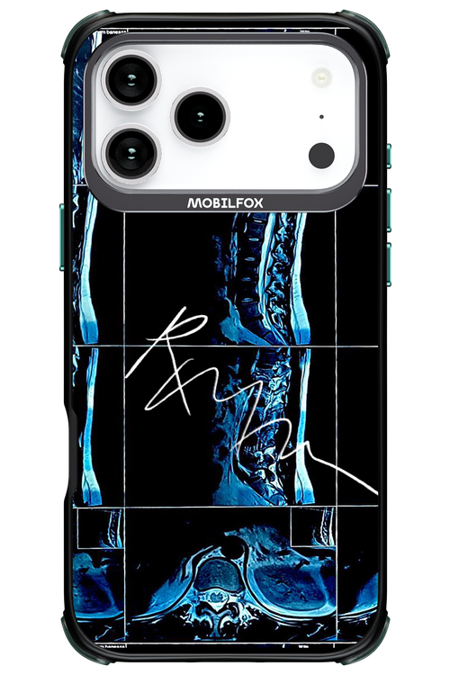 RMN Scolioza 2.0 - Apple iPhone 17 Pro Max