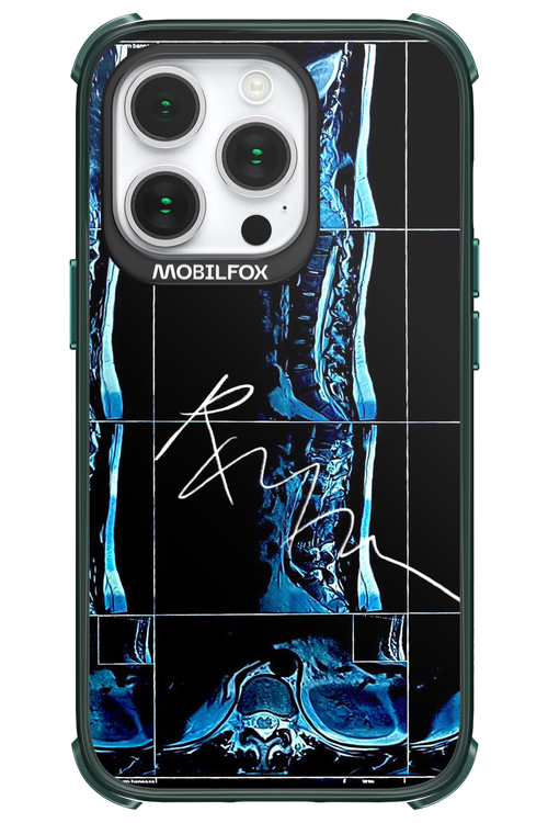 RMN Scolioza 2.0 - Apple iPhone 14 Pro